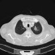 Pulmonary infiltrates, pleural effusion: CT - Computed tomography